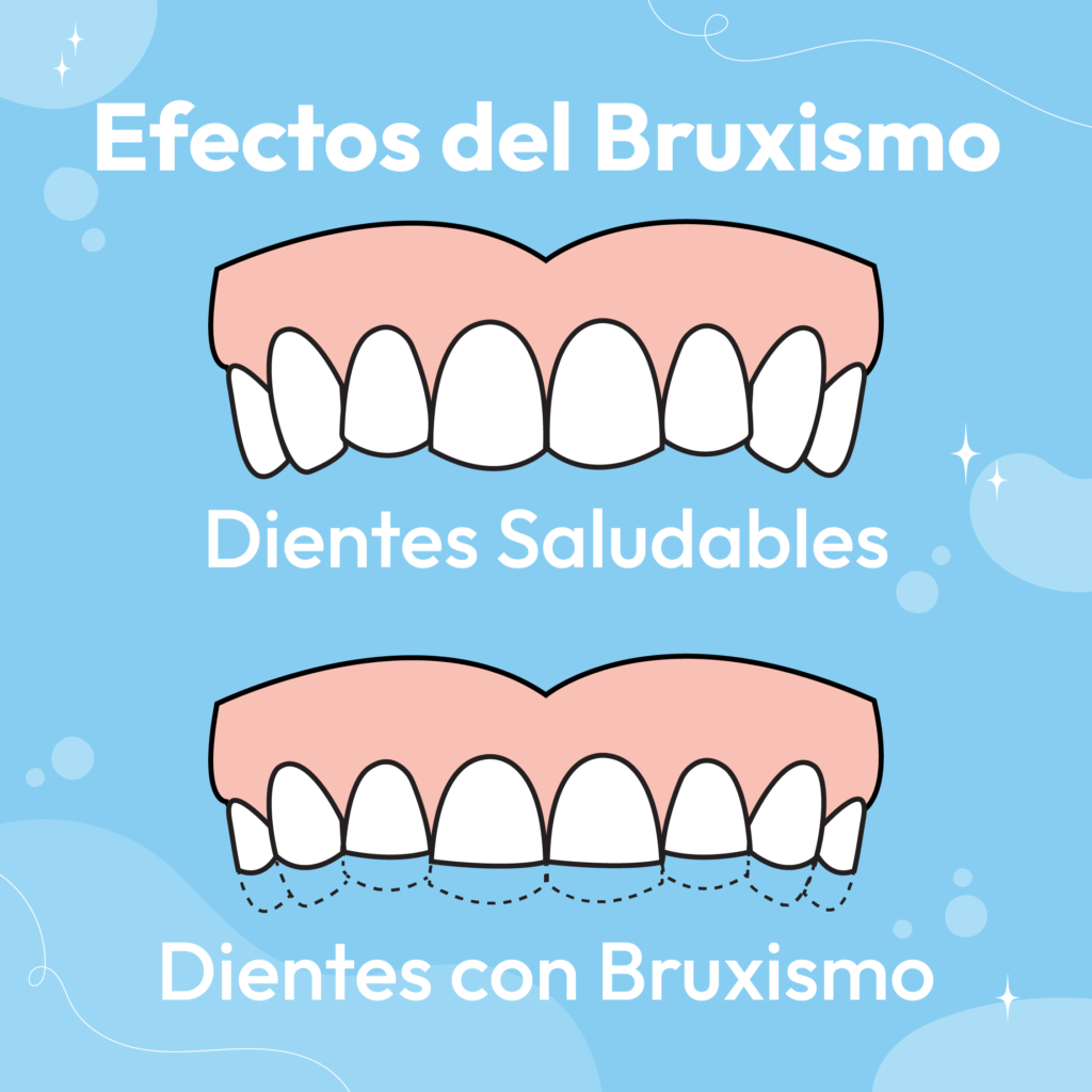 Bruxismo en niños